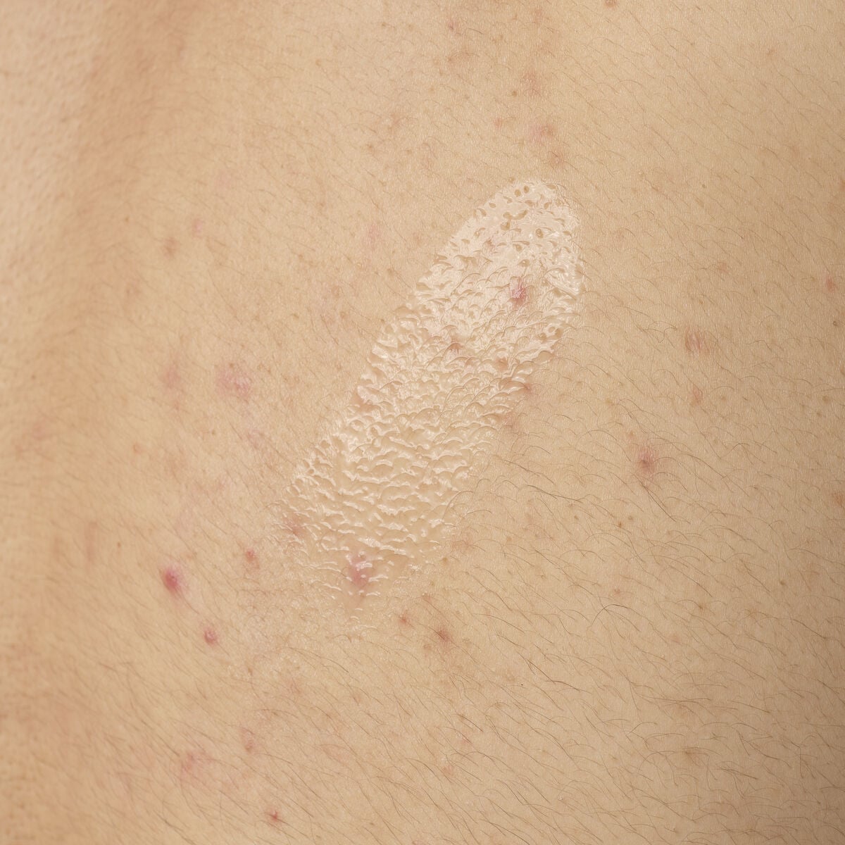 salicylic-acid-0-5-body-serum-v4 ORD-salicylic-acid-05-body-240ml-application.jpg