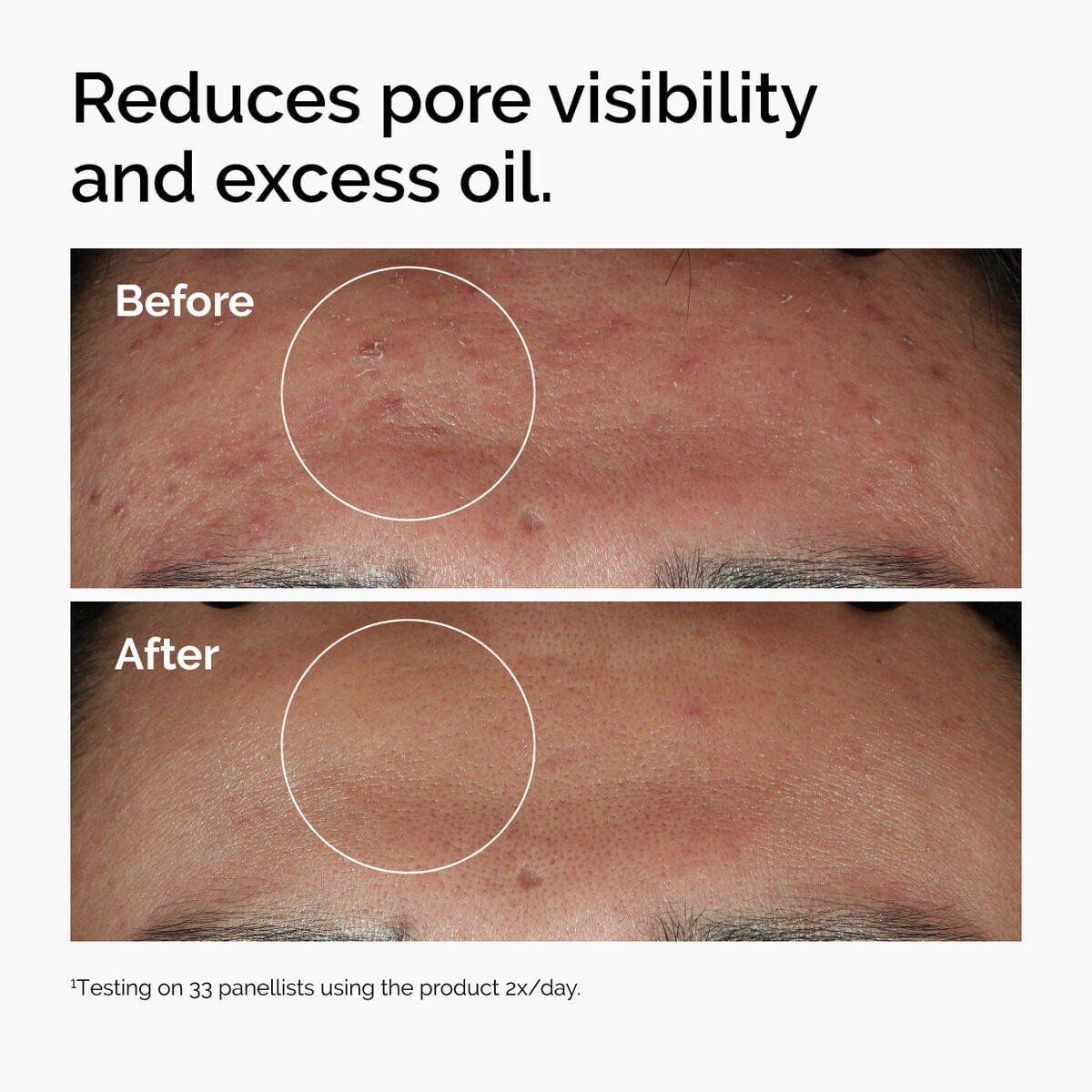 niacinamide-10-zinc-1-f7 ord-niacinamide-zinc-blemish-serum-before-after-pores.jpg