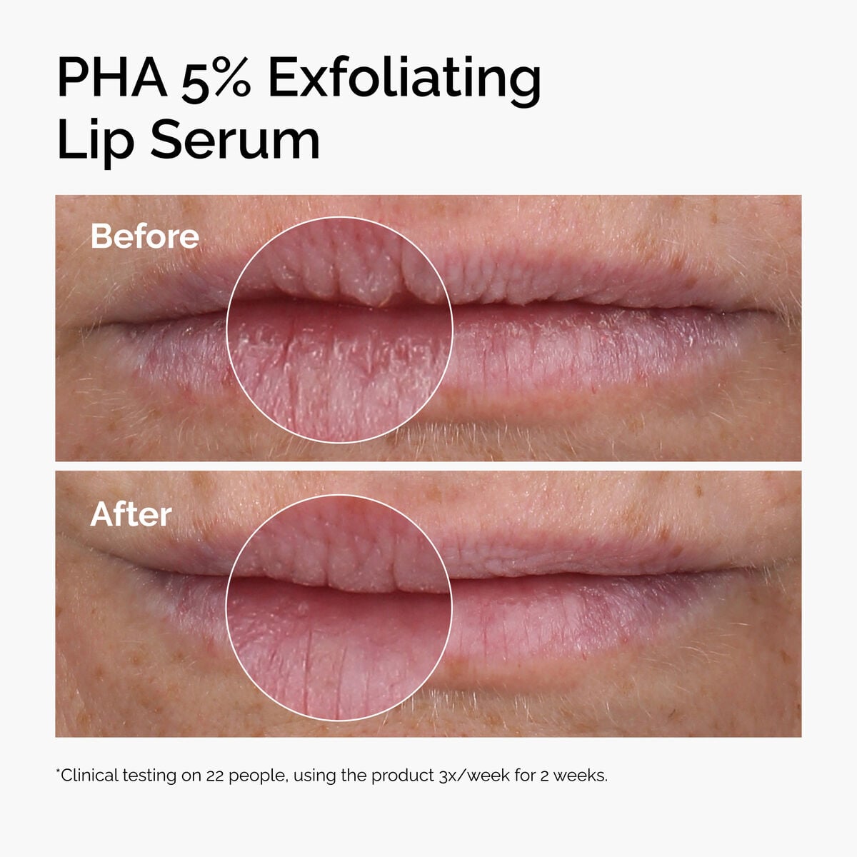 pha-5-exfoliating-lip-serum-q9 ord-pha-5pct-lip-exfoliating-serum-before-after.jpg