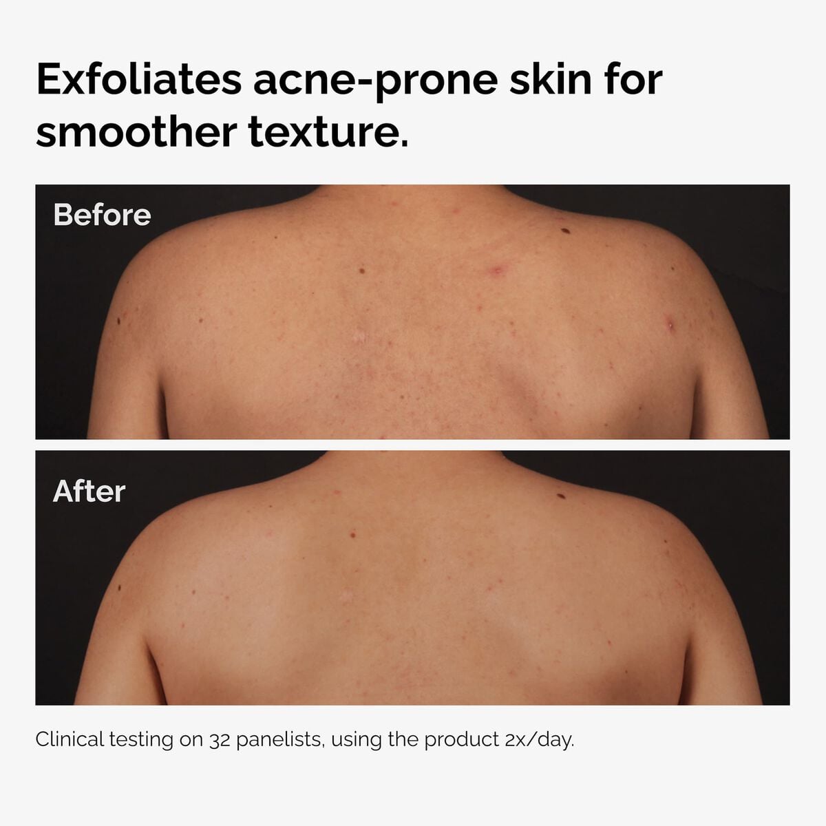 salicylic-acid-0-5-body-serum-v4 ord-salicylic-acid-body-serum-before-after-graphic-NA.jpg