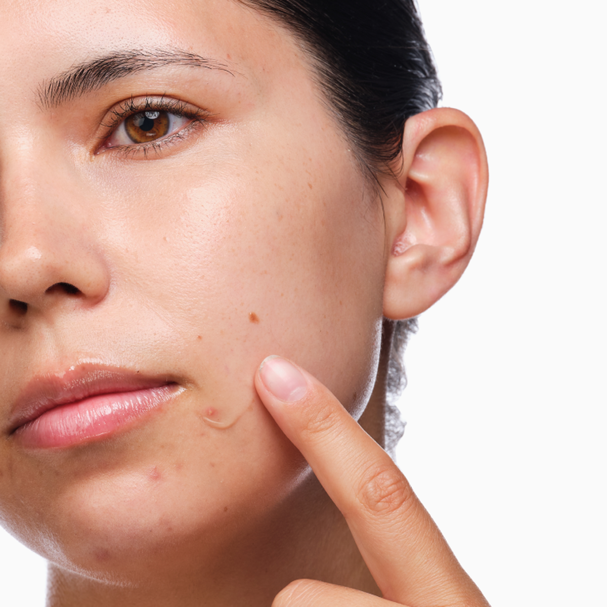 the-acne-set-s8 rdn-the-acne-set-application.png